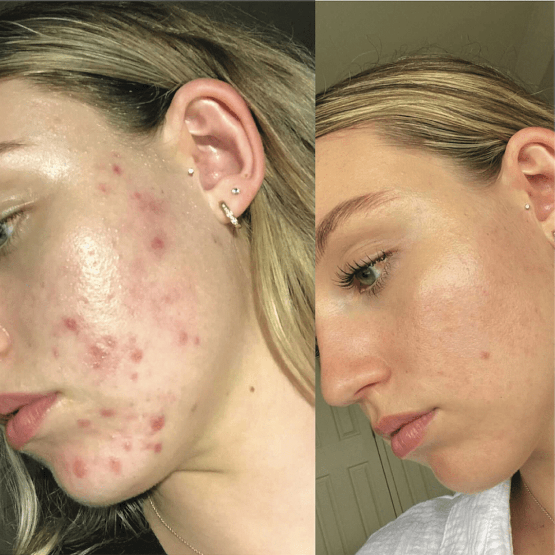 Before and after comparison of a woman's face with acne on one side and clear skin on the other.