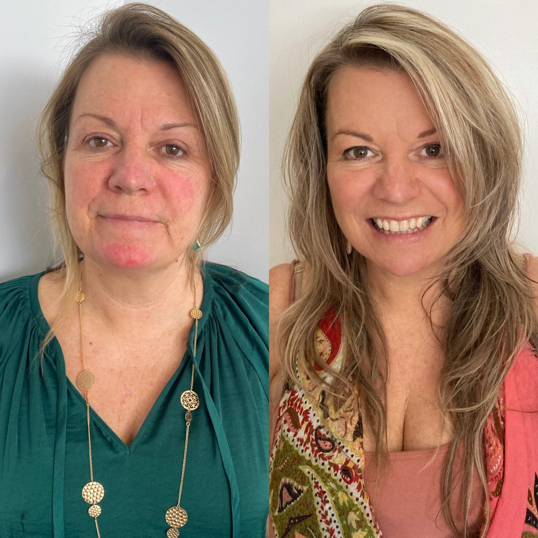 Comparison of a woman before and after using Face Tan Water to treat Rosacea