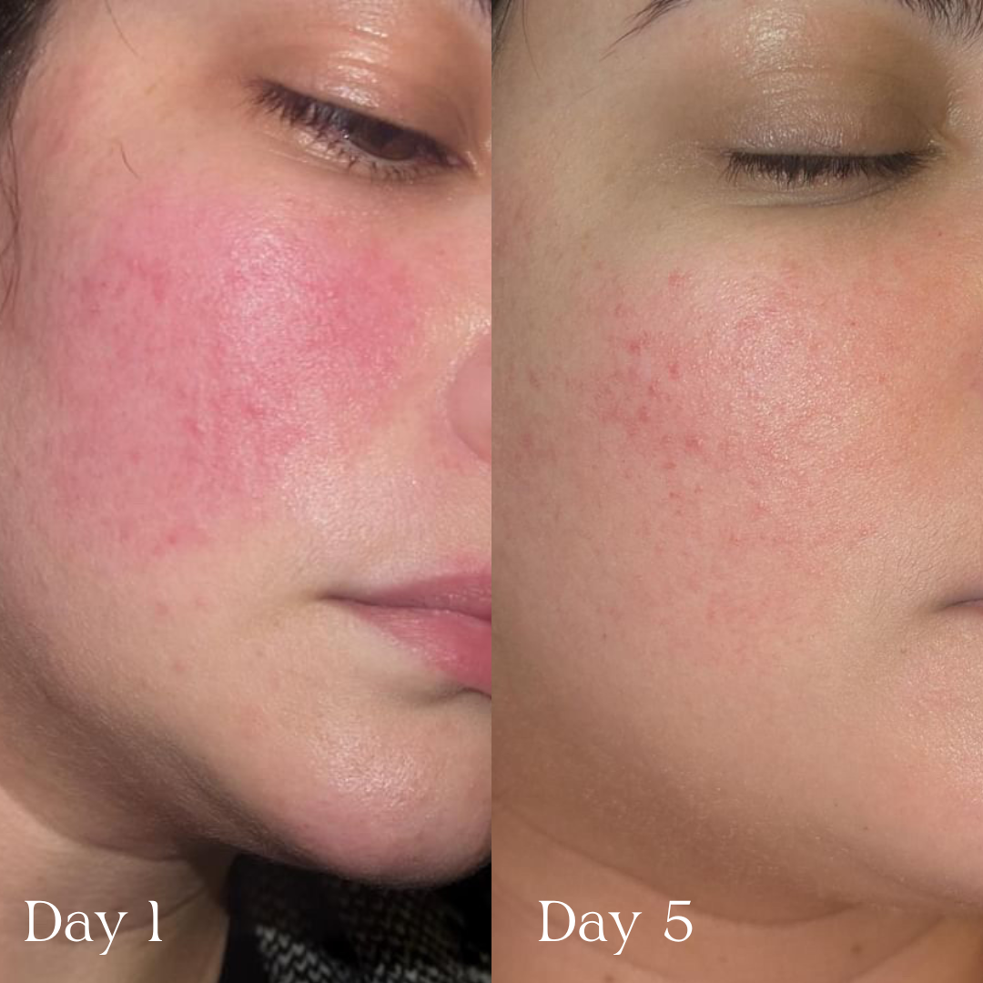 Before and after comparison of a person's face with visible skin conditions on Days 1 and 5 after using Glory Oil