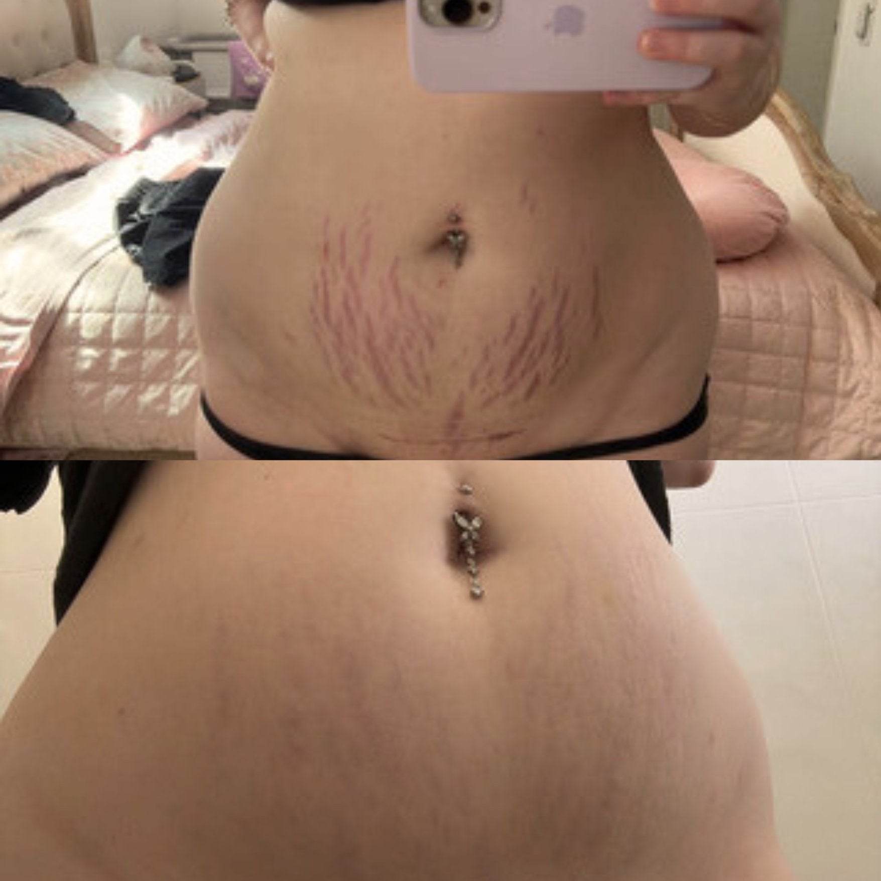 Stretch marks before and after using Glory Oil on stomach skin