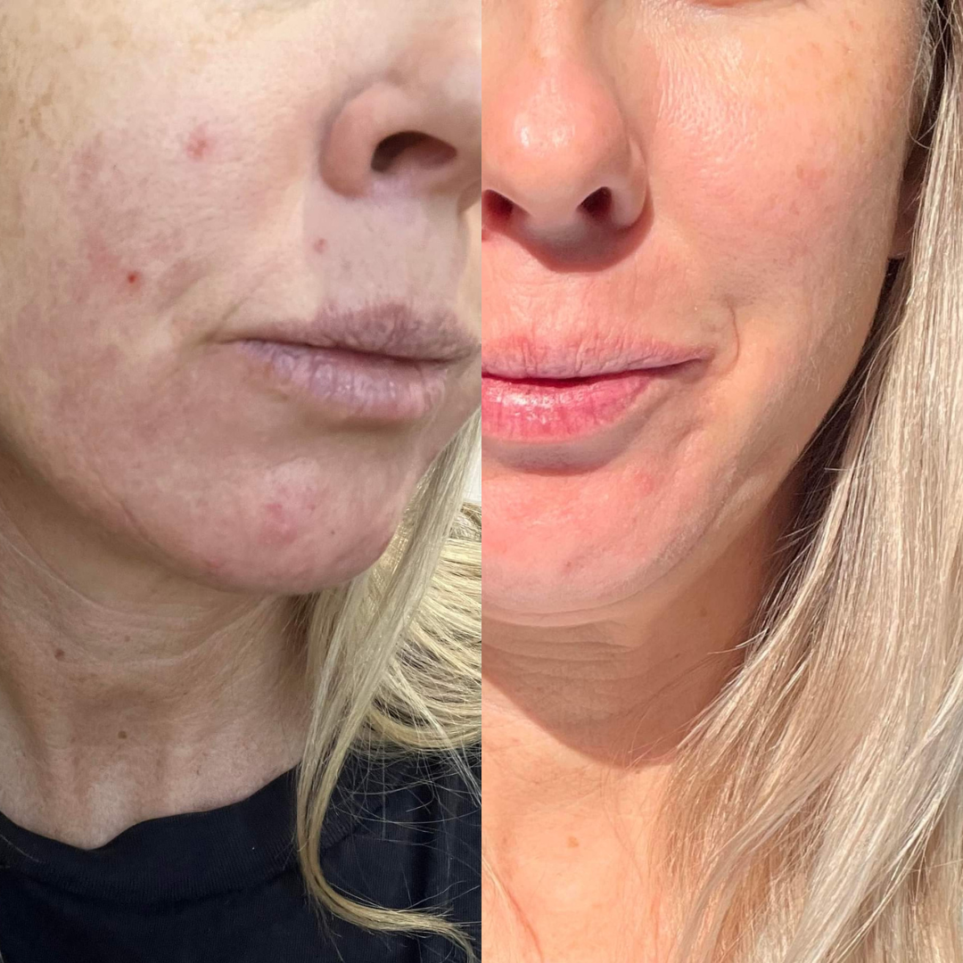 Comparison of a person's face with visible skin conditions before and after using Hydration Skin System