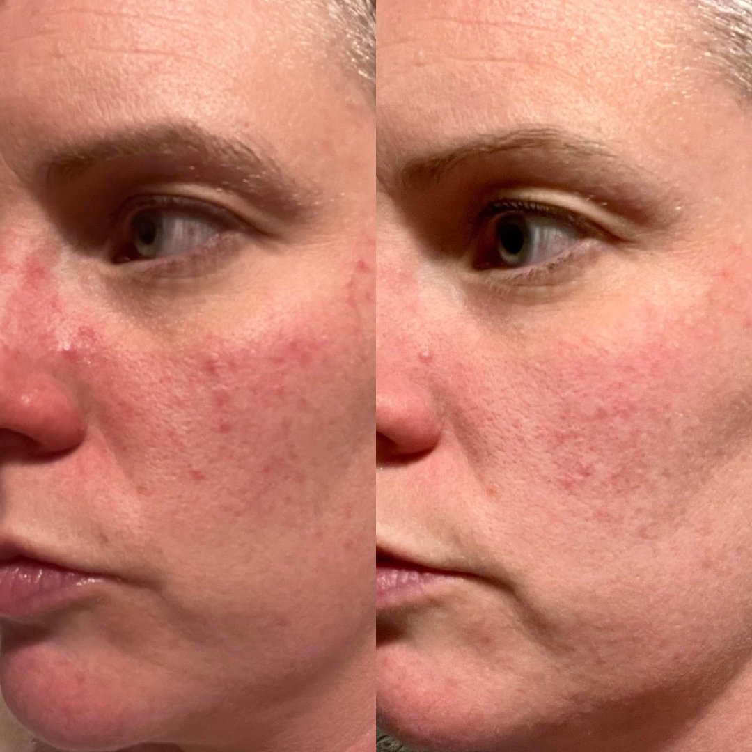 Serum Of Clear natural serum before after results on face for acne, redness and evening skin tone